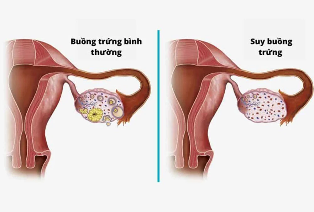10 nguyên nhân phổ biến khiến vợ chồng khó mang thai tự nhiên