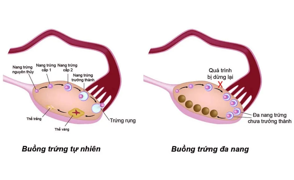 Nữ công nhân thiếu ngủ, ăn uống thất thường – Mối nguy vô hình với sức khỏe sinh sản!