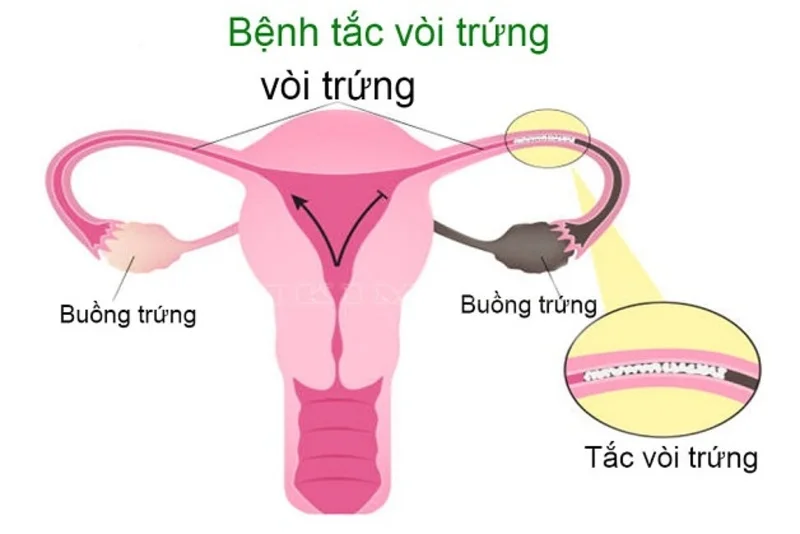 Đa nang, tắc vòi trứng… vẫn có cách giúp bạn tăng cơ hội đậu thai tự nhiên