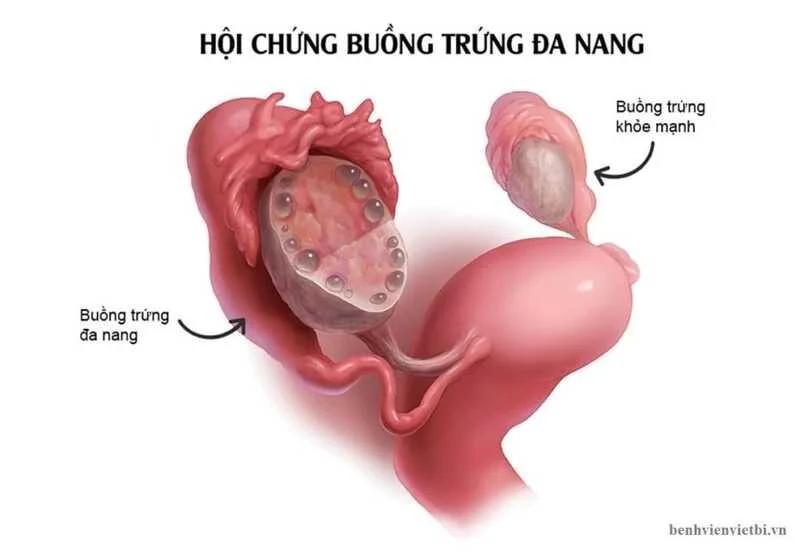 Liệu trình INC dành cho nữ: PCOS, AMH thấp, tắc vòi trứng – nên bắt đầu từ đâu?