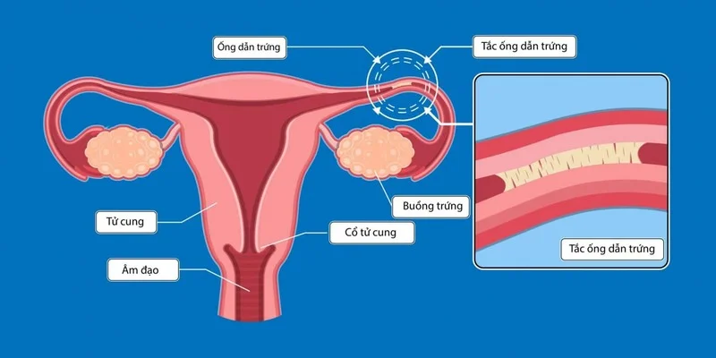 Liệu trình INC dành cho nữ: PCOS, AMH thấp, tắc vòi trứng – nên bắt đầu từ đâu?