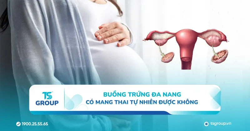 Buồng trứng đa nang có mang thai tự nhiên được không