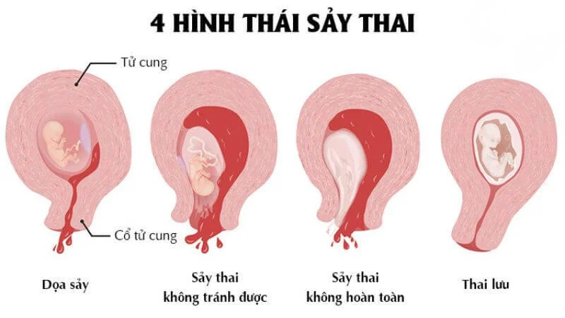 Thả bầu sau sảy thai bao lâu là an toàn